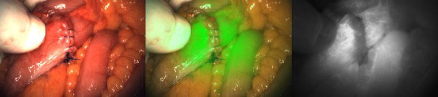 anastomoses colorectales